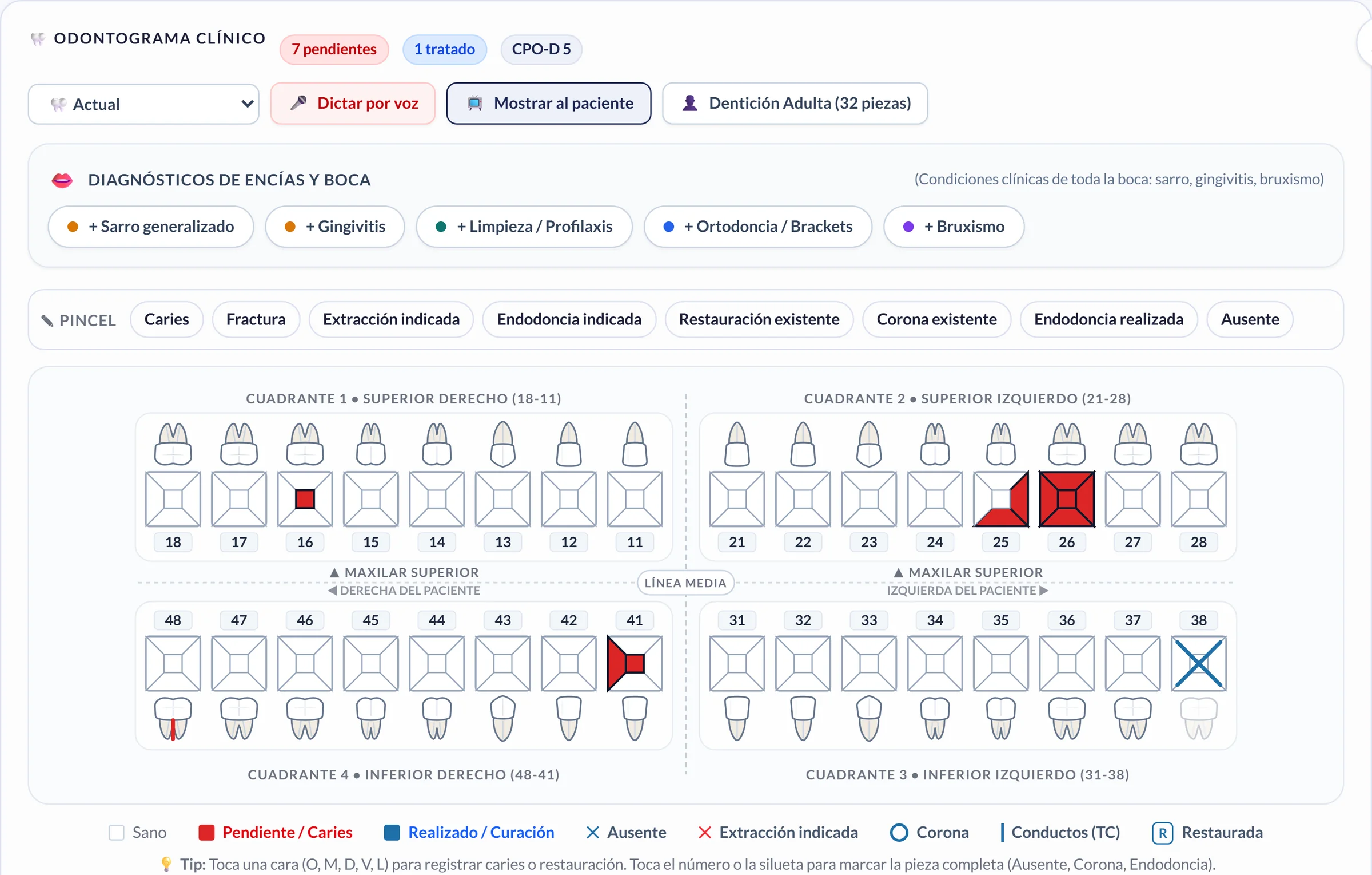 Odontograma clínico en Sania con piezas marcadas por caries y extracción indicada